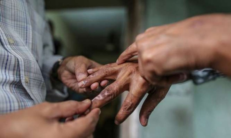 कुष्ठरोग निवारणमा गण्डकी प्रदेश पहिलो