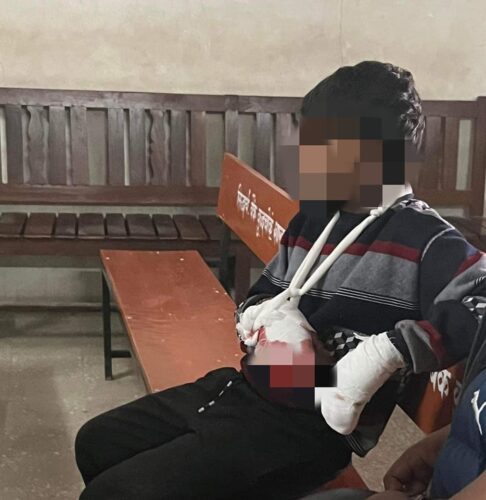 पोखरा-३३ मा विष्फोटक पदार्थ पड्किँदा २ बालक घाइते